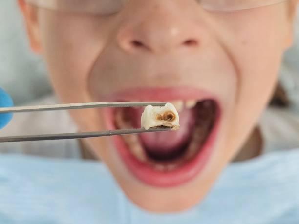 Best Emergency Wisdom Teeth Removal in Weirton, WV